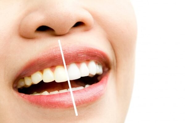Dazzling White Teeth Whitening Pen - Easy Instant Tooth Bleaching Gel for Stain Removal & Oral Hygiene
